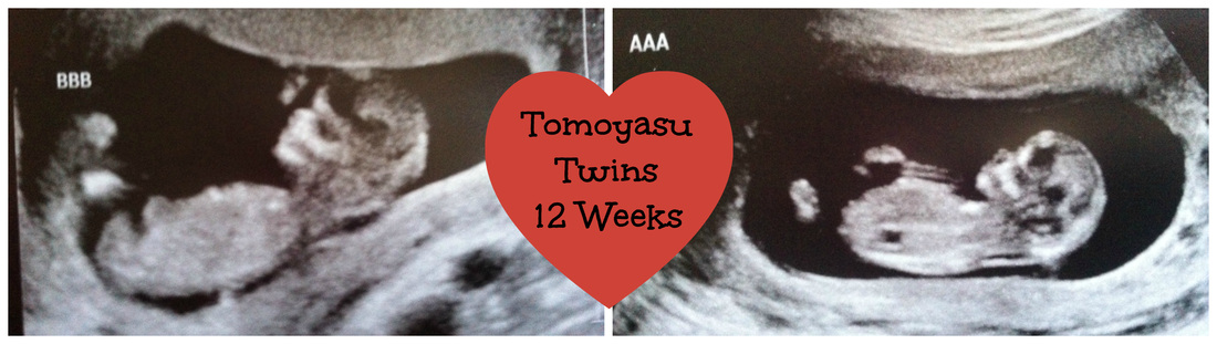 My di/di twins at 12 weeks gestation