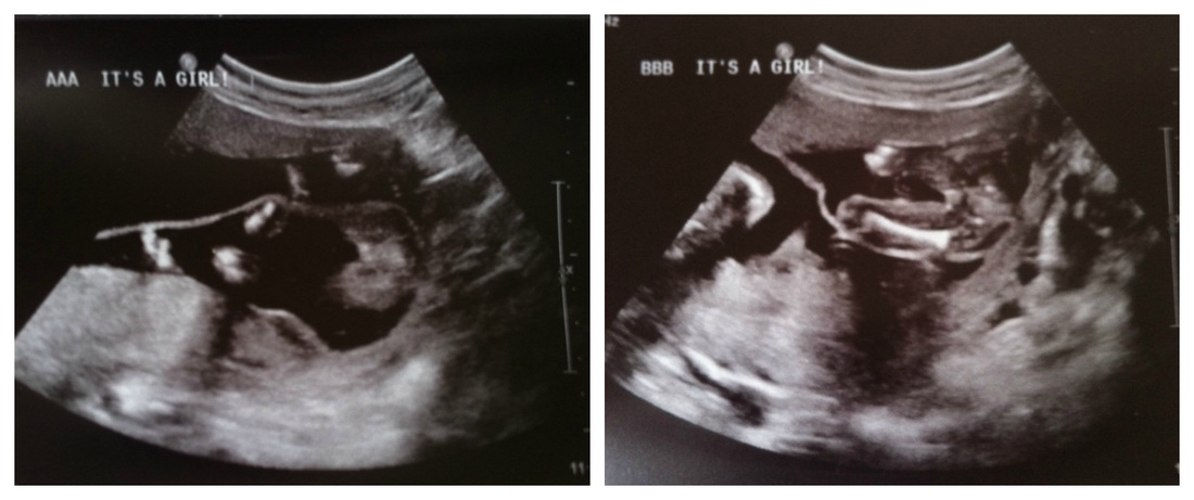 18 week twin gender scan - girls