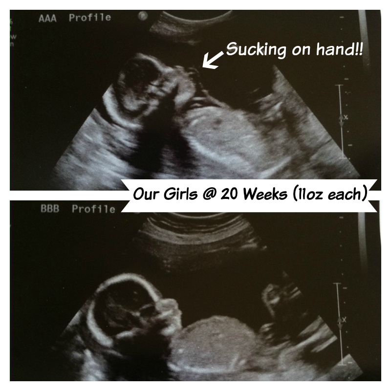 20 Week Twin Pregnancy Update