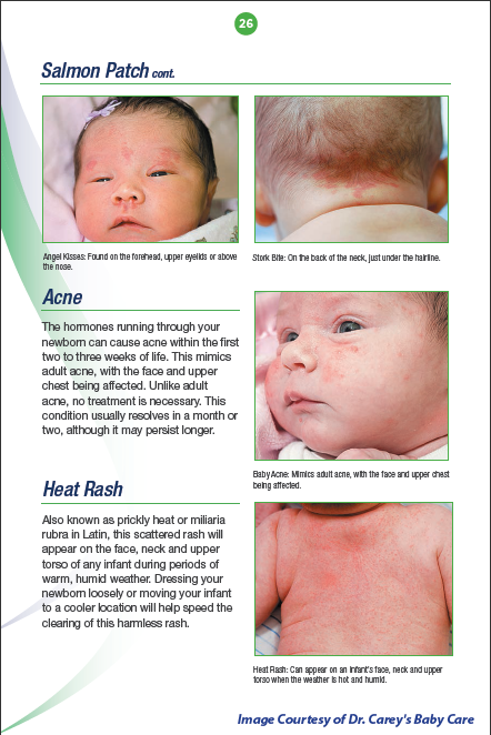 Baby Acne and Heat Rash photos depicted in Dr. Carey's Baby Care Book, reviewed by US-Japan Fam